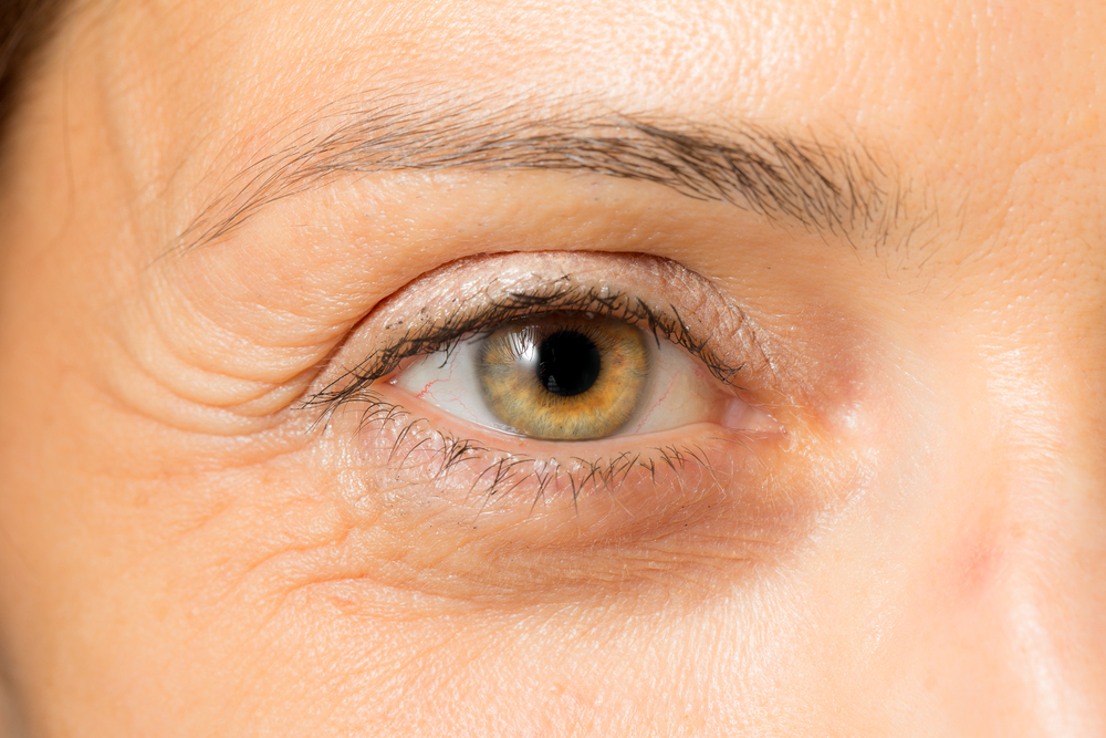 درمان خطوط پنجه کلاغی دور چشم